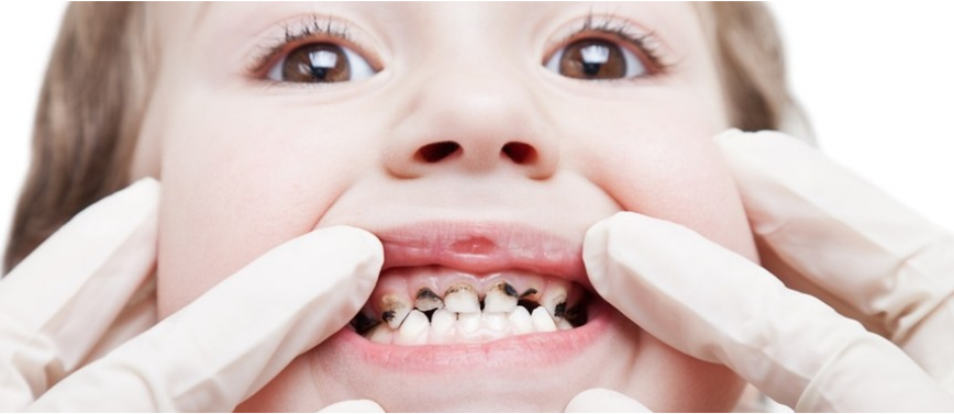  تسوس الأسنان